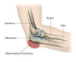 Olecranon fractures are common and occur at the pointy end of the elbow. Elbow Olecranon Bursitis Orthoinfo Aaos