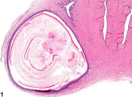Uterus Cervix Cyst Squamous Nonneoplastic Lesion Atlas Christensen for the laboratory sessions he conducted in the medical histology course for first year medical students. uterus cervix cyst squamous