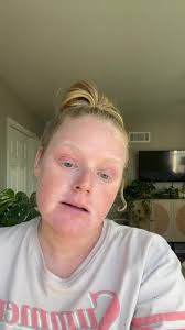 DUPIXENT UPDATE #greenscreen #dupixent #eczema #tsw  #topicalsteroidwithdrawal #topicalsteroidaddiction #fyp