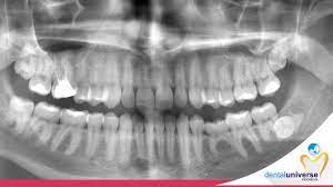 We did not find results for: Pentingnya Melakukan Rontgen Gigi Sebelum Pemasangan Behel Dental Universe Indonesia