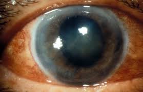 Image result for Acute Red Eye