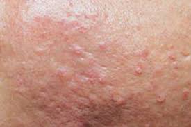 Image result for Sebaceous Hyperplasia