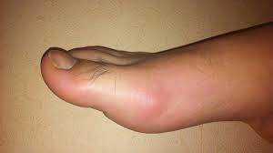 Image result for gout symptoms toe