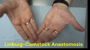 Image result for Elson Extensor Tendon Test