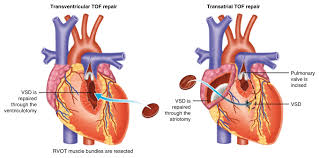 Basic anatomy and pathophysiologyplease visit: Current Outcomes And Treatment Of Tetralogy Of F1000research