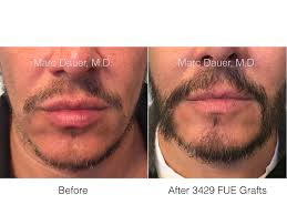 Hair restoration costs anywhere from $1,500 to $10,000. Facial Transplant Beard Hair Transplant Before And After Photos Los Angeles Hair Restoration