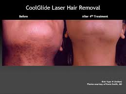 Milan laser hair removal san antonio. Laser Hair Removal Southflorida Aesthetics