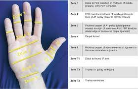 The fds and fdp tendons should be tested individually; Flexor Tendon Injuries Of The Upper Extremity Springerlink