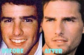 The stigma surrounding plastic surgery is disappearing as more mothers share their experiences, and why surgery was right for them. Tom Cruise Plastic Surgery Before And After Plastic Surgery Nose Job Celebrity Plastic Surgery