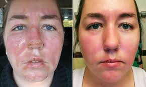 Fort Worth baker who suffered sugar burns reveals progress