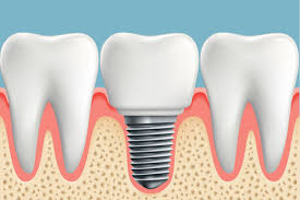 Pin On Dental Crown Mouths