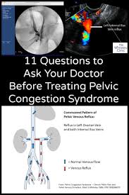 Questions To Ask Your Doctor Before Treating Pelvic Congestion Syndrome