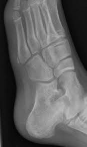 Image result for Growth Plate