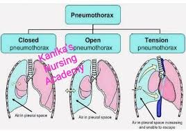 Prevention & recovery period of collapsed lung or pneumothorax Types Of Pneumothorax Kanika S Nursing Academy Facebook