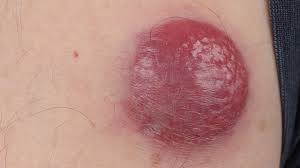Image result for Merkel Cell Carcinoma