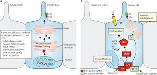 Findings can be local (eg, reflecting kidney inflammation or mass). Autosomal Dominant Polycystic Kidney Disease The Lancet