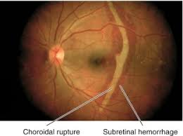 Image result for Choroid