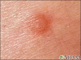 Image result for flea bite