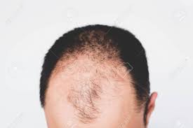 This is your father's male patterned baldness. Male Pattern Hair Loss Problem Concept Young Man Losing Hair Stock Photo Picture And Royalty Free Image Image 147107385