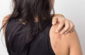 Why Am I Breaking Out In Hives When I M Stressed Cleveland Clinic