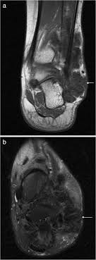 Learn more details about them at kenhub! Mri Imaging Of Soft Tissue Tumours Of The Foot And Ankle Insights Into Imaging Full Text