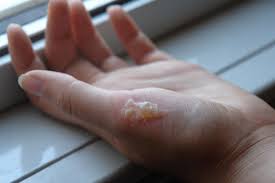 A 1st degree burn is just the first few layers of skin and causes redness (such as a carpet burn.) Treatment For First Degree Burns