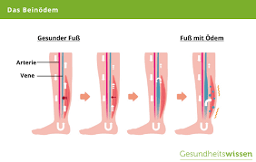 Beinodeme Entstehung Arten Ursachen Behandlung