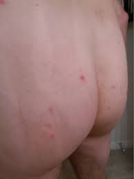 Bumps hsv 2 pictures on buttocks. Red Bumps Persist Butt And Back Pictures Attached Genital Herpes Simplex Forums Patient