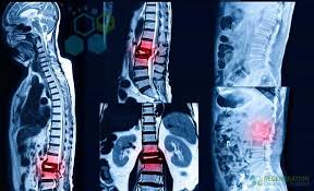 Image result for Vertebral Compression Fracture