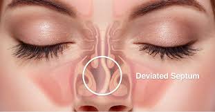 A deviated septum can be caused by compression of the nasal area during childbirth. Septoplasty In San Francisco Deviated Septum Surgery Dr Albert Chow