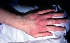 Image result for contact dermatitis