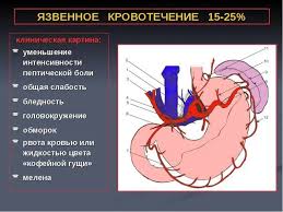 Krovotechenie Pri Yazve Zheludka Prichiny Simptomy Lechenie Dieta Prognoz Vasha Onlajn Bolnica