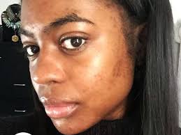 The skin around your mouth can become dark due to hyperpigmentation 1, which is a very common cause. I Finally Found The Perfect Skincare Routine For Dark Spots