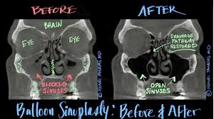 Image result for Sinus CT