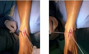The extensor digitorum longus and extensor hallucis longus also extend the toes. Traumatische Ruptur Der Extensor Hallucis Longus Sehne Schulthess Klinik