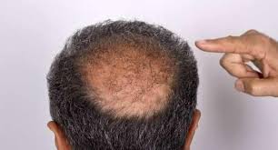 Hair loss due to ferritin deficiency is a treatable and completely reversible condition. Severe Hair Loss Could Be A Sign Of Vitamin D Deficiency 247 News Around The World