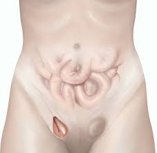 An inguinal hernia occurs when the intestines or fat from the abdomen bulge through the lower abdominal wall into the inguinal, or groin, area. Open Inguinal Hernia Repair Female Healthdirect
