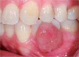 Image result for granuloma gum disease