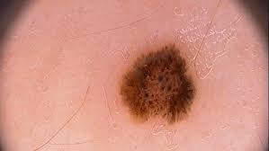 Image result for Spitz Nevus