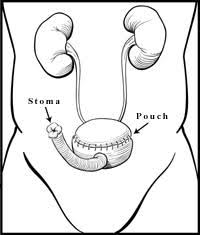 Urinary Diversion What Is It Types Surgery Options