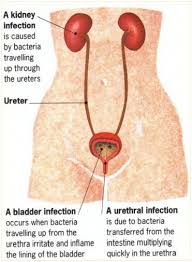 Cystitis Is The Inflammation Of The Bladder Produced Principally By A Bacterial Infection Fr Urinary Tract Infection Home Remedies For Uti Natural Cure For Uti