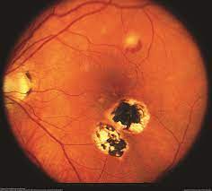 Wet amd is when abnormal blood vessel behind the retina start to grow under the macula, ultimately leading to blood and fluid leakage. Presumed Ocular Histoplasmosis Syndrome The American Society Of Retina Specialists