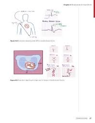 Image result for Bundle Branch Block