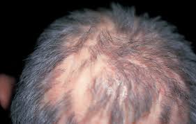 But it may be due to certain antibodies produced by some people with lupus. What Caused Hair Loss And A Pruritic Scalp Consultant360