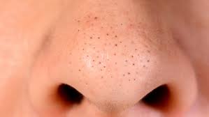 Closed comedones look like little bumps across the skin's surface. The Truth About Comedonal Acne