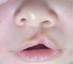 Fotografia de paciente pediatrico con malformación de paladar hendido. 10 Ideas De Labio Y Paladar Hendido Labio Leporino Leporino Desarrollo Fetal
