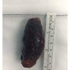 A centimeter (cm) is a decimal fraction of the meter, the international standard unit of length, approximately equivalent to 39.37 inches. Photograph Of The Large 7 Cm Gallstone Removed From The Transverse Colon Download Scientific Diagram