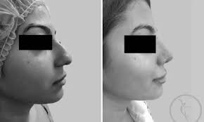 Ce trebuie sa stii despre operatia de rinoplastie rinoplastia este interventia chirurgicala de imbunatatire a aspectului extern al nasului, ce contribuie. Poze Rinoplastie Operatii Dr Rachad Art Estetica