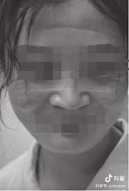 2 Doctor's imprinted face as a result of wearing a face mask for an...