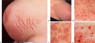 Image result for pruritic urticarial papules and plaques of pregnancy